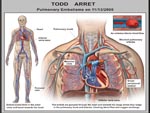 Click to enlarge: Pulmonary Embolism