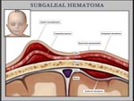Click to enlarge: Hematoma