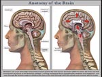 Click to enlarge: Brain Tonsillar Herniation