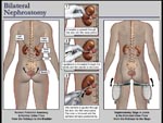 Click to enlarge: Nephrostomy